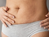 Чому з’являються розтяжки на тілі і що з ними робити