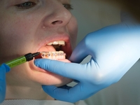 Как проходит выравнивание зубов брекетами: что стоит знать перед началом лечения