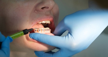 Як проходить вирівнювання зубів брекетами: що варто знати перед початком лікування