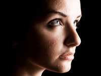 Эти противные угри...что же делать?