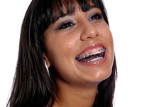 Керамические брекеты: красота зубов не требует жертв