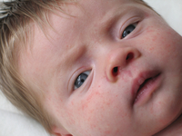 Что делать, если у малыша атопический дерматит