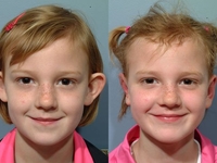 7-летней школьнице сделали пластическую операцию