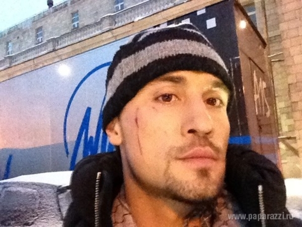 Дима Билан расцарапал лицо