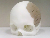Хирургам удалось восстановить 75% черепа человека с помощью 3D-печати