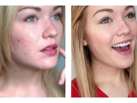 История борьбы с акне: До и после болезни