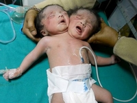 Женщина родила двухголового ребенка