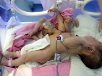 Ребенок родился с четырьмя ногами и руками