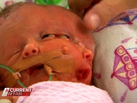 Женщина родила близнецов с одним телом и двумя лицами