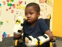 40 врачей сумели пересадить кисти рук 8-летнему мальчику