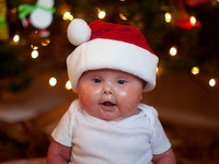 Вдохновляет: История одной маленькой девочки с синдромом ихтиоза