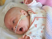 Девочка родилась на свет на 13 недель раньше срока