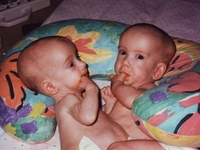 Одна жизнь на двоих: История милых сиамских близнецов