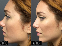 Невероятно: Пластика носа за пять минут