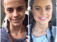 Победа над анорексией: Клэр Мерсер в 19 лет весила всего 25 кг