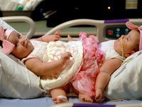 В США удачно разделили сиамских близнецов, сросшихся в области таза