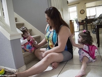 Врачи успешно разделили уникальных сиамских близнецов