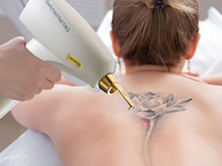 Удаление татуировки: дерматолог ответила на главные вопросы