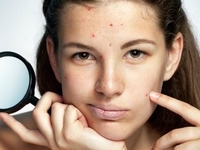 Макияж при акне: 5 основных правил