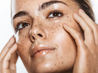 Ни пятнышка: как бороться с веснушками