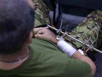 #Врятуйкінцівку: в Україні стартувала національна програма