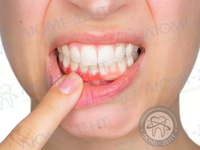 Воспаление десен в вопросах и ответах от специалистов