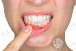 Воспаление десен в вопросах и ответах от специалистов