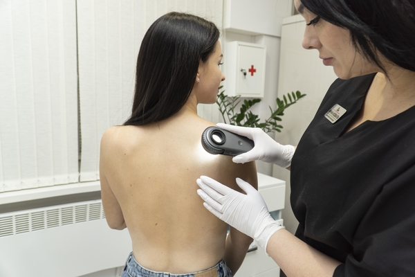 Основные причины появления папиллом, их виды и безопасные методы удаления